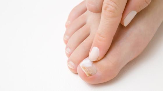 ما هي أسباب تقصف أظافر القدم؟ اكتشف العوامل البسيطة والخطيرة المؤثرة على صحتها