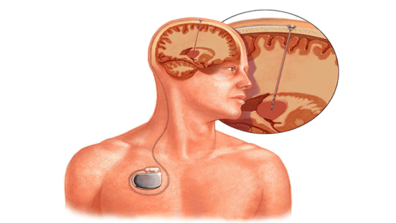 إنجاز طبي عالمي: كيف أعادت تقنية التحفيز العميق للدماغ الأمل لمرضى الشلل؟